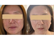 リズ(rE:S)/韓国インモード/角栓除去 50代