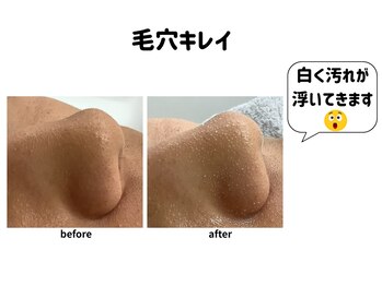 ゴールドプラス 日田店(GOLD PLUS)/毛穴キレイ