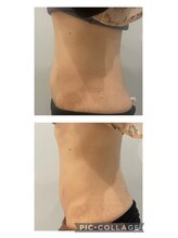 ルナート(Lunart)/腸もみの一回の変化