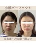 お試し【エラ張り/左右差/巻き肩】小顔・美姿勢・噛み締めケア◎