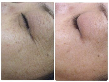 ナチュライズ(NatuRise)/小じわ改善