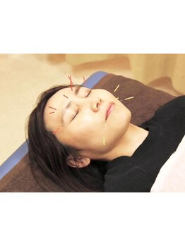 鍼灸施術を受けたい