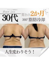 プリマルーチェ/３０代　脂肪冷却 before　after