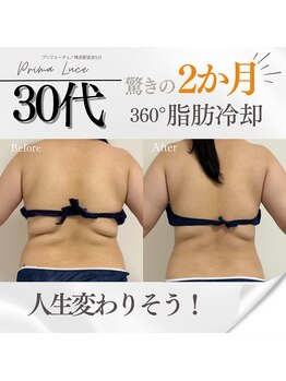 プリマルーチェ/３０代　脂肪冷却 before　after