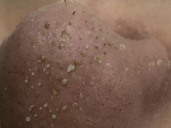 サラグランデ(Sara Grande)/毛穴の大掃除で鼻の形変わります