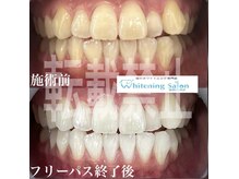 ホワイトニングサロン 福岡天神店/ホワイトニング