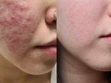 マリヴェリーテ(Mari verite)の雰囲気（毛穴洗浄×韓国式イオン導入でトラブルのない美肌に導きます。）