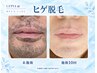【ヒゲ脱毛】毎朝のヒゲ剃りが気になる方へ｜初回