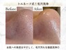 【毛穴の黒ずみ・開きに◎】30代後半からの毛穴ケア◎毛穴洗浄+引き締めケア