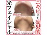 【女性】ニキビケアに◎光フェイシャル+生パック付き♪　通常￥6000