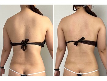 モア(moa)/背中スッキリ