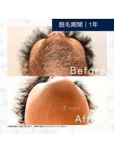 メンズクリア 八王子店/【メンズクリア】お客様の施術例