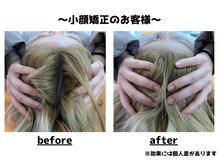 トータルビューティーみつとも/小顔矯正/インディバ/EMS