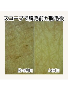 サロン ウーカ(salon WOOCA)/脱毛