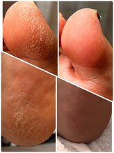 リ ベル(Re:Bell)/かかと角質ケア