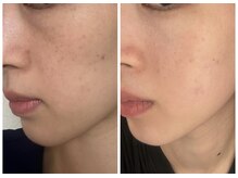 カムイ/ハーブピーリング3回