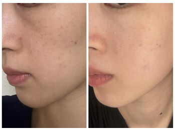 カムイ/ハーブピーリング3回