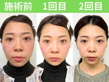 ナチュラルビューティーフェイス 横浜(NBF)/小顔矯正/ビフォーアフター