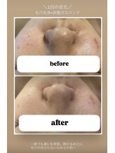 エヌ(enu)/毛穴洗浄/フェイシャル