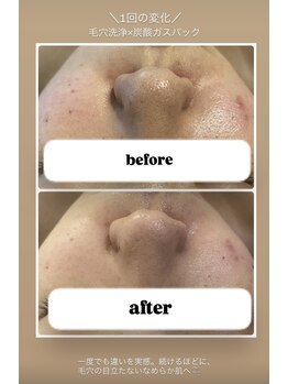 エヌ(enu)/毛穴洗浄/フェイシャル