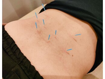 カバ(Kaba)/鍼の施術で腰痛ケア