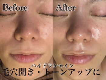 アンドエス 六本木(and S.)/毛穴の開き・くすみが気になる方