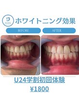 R24 梅田店/ホワイトニング効果