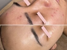 エイプリルフールズ(April fools)/【20代】本来の美しいお肌へ！