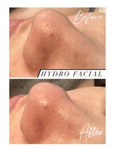 グラント(grant)/【毛穴洗浄】ビフォーアフター