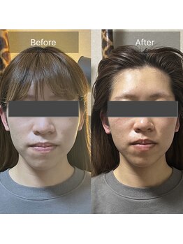 リノリー(rinory)/小顔矯正