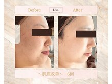 リーフ(Leaf.)/肌質改善