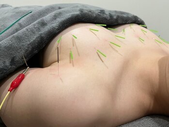 ハリスタ 六本木院(HARISTA)の写真/美乳鍼でふっくら、上向きバスト!open価格で0円で体験★経験豊富なスタッフによる信頼の施術で満足度◎