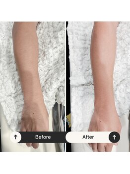 久遠(クオン)/メンズ 腕脱毛 2025/9/15