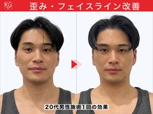 顔ジム 麻布十番店/20代男性　男の小顔矯正！