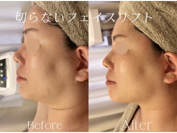 エービューティーサロン 松山店(A BEAUTY SALON.)の写真/【40代たるみケア悩み】リフトUP特化の最新低周波マシン『テラボーラー』導入!