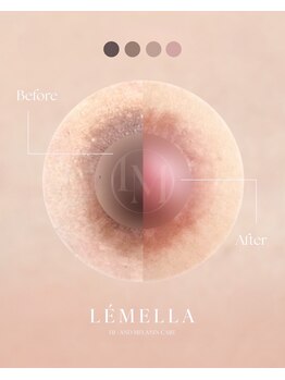 エルビービュティーサロン(LB BEAUTY SALON)/【ルメラ乳輪】実績数関西1★