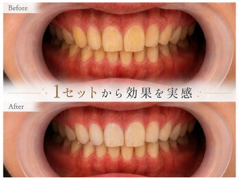 スールボーテ(soeur beaute)の写真/《笑顔を引き立てる白い歯へ♪》第一印象を左右する歯のケア始めませんか？食事制限なし！本来の白さへ★