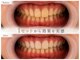 スールボーテ(soeur beaute)の写真/《笑顔を引き立てる白い歯へ♪》第一印象を左右する歯のケア始めませんか？食事制限なし！本来の白さへ★