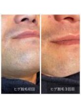 ブリッシュ(Bullish)/ヒゲ脱毛 3回目照射後の途中経過