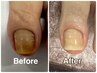 【FOOT巻き爪でお悩みの方】爪を広げる巻き爪ケア2本/ネイルケア基本コース込