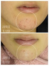 ラミーユ(La Miu)/あご肌荒れ/赤み改善