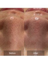 マヴィ(Mavie)/韓国式3D毛穴洗浄