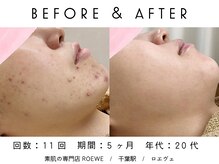 ロエヴェ(ROEWE)/ニキビ改善・毛穴ケア・肌質改善