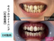 ベルホワイト(Belle White)/【医療提携W.N/1回】