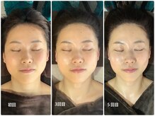 アベリア リュウ(Aberia Lieu)/頭蓋骨小顔矯正/小顔矯正