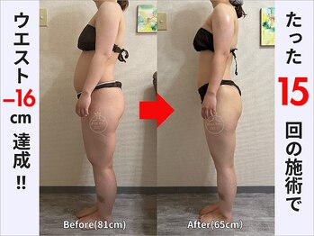 ぷりんす整体コージー(COZY)/【20代 女性】ビフォーアフター