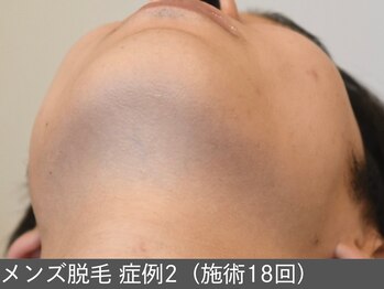 オアシスラグーン(OASIS LAGOON)/メンズ脱毛(症例2 施術18回)