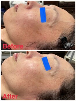 ソレイユ/バクテリウムピール