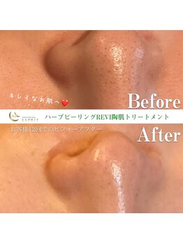 エスプリ 銀座店/ハーブピーリング銀座