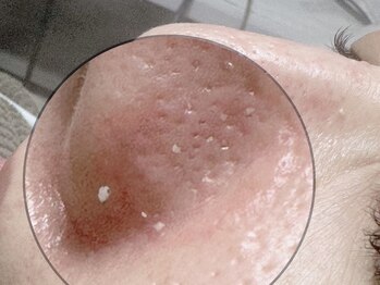 パールフェイスエステ ルペルル(PEARL FACE ESTHE la perle)/毛穴洗浄